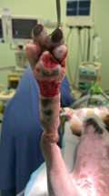 Nellie's leg is raised in theatre during her surgery