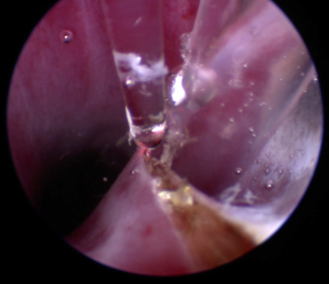 View through scope during ectopic laser surgery