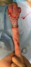 Nellie's skin graft after surgery